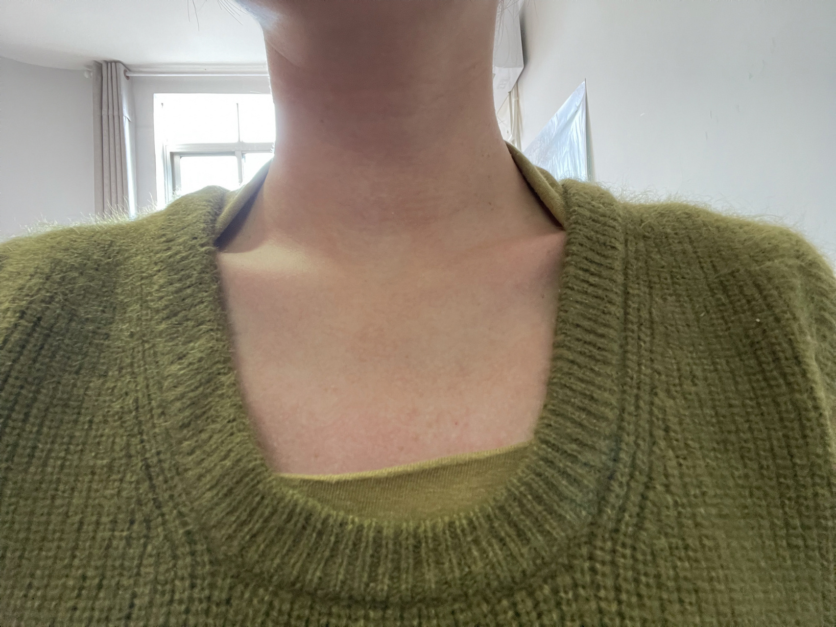 紫外线过敏 光过敏 咱就是说整一个大无语94我这二十几年来莫名其妙