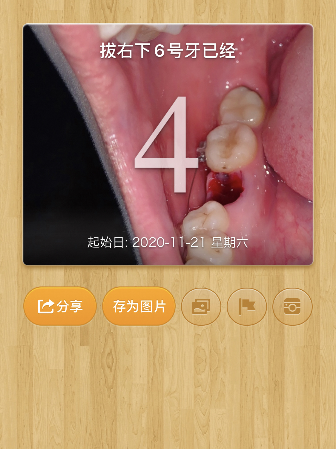 我在想我为什么要正畸…拔牙第4天干槽症 哎～原来拔牙才是痛苦的.