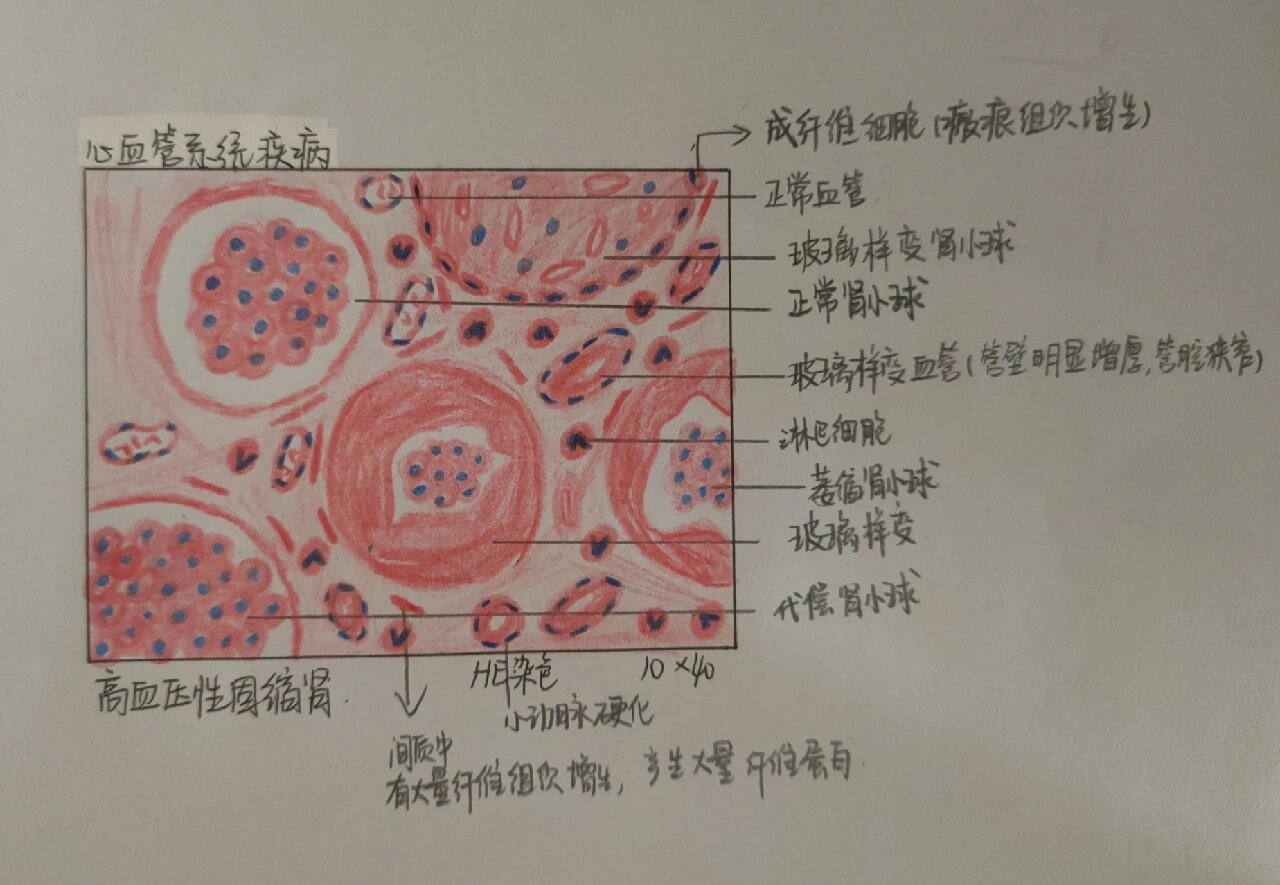 动脉粥样硬化切片图解图片