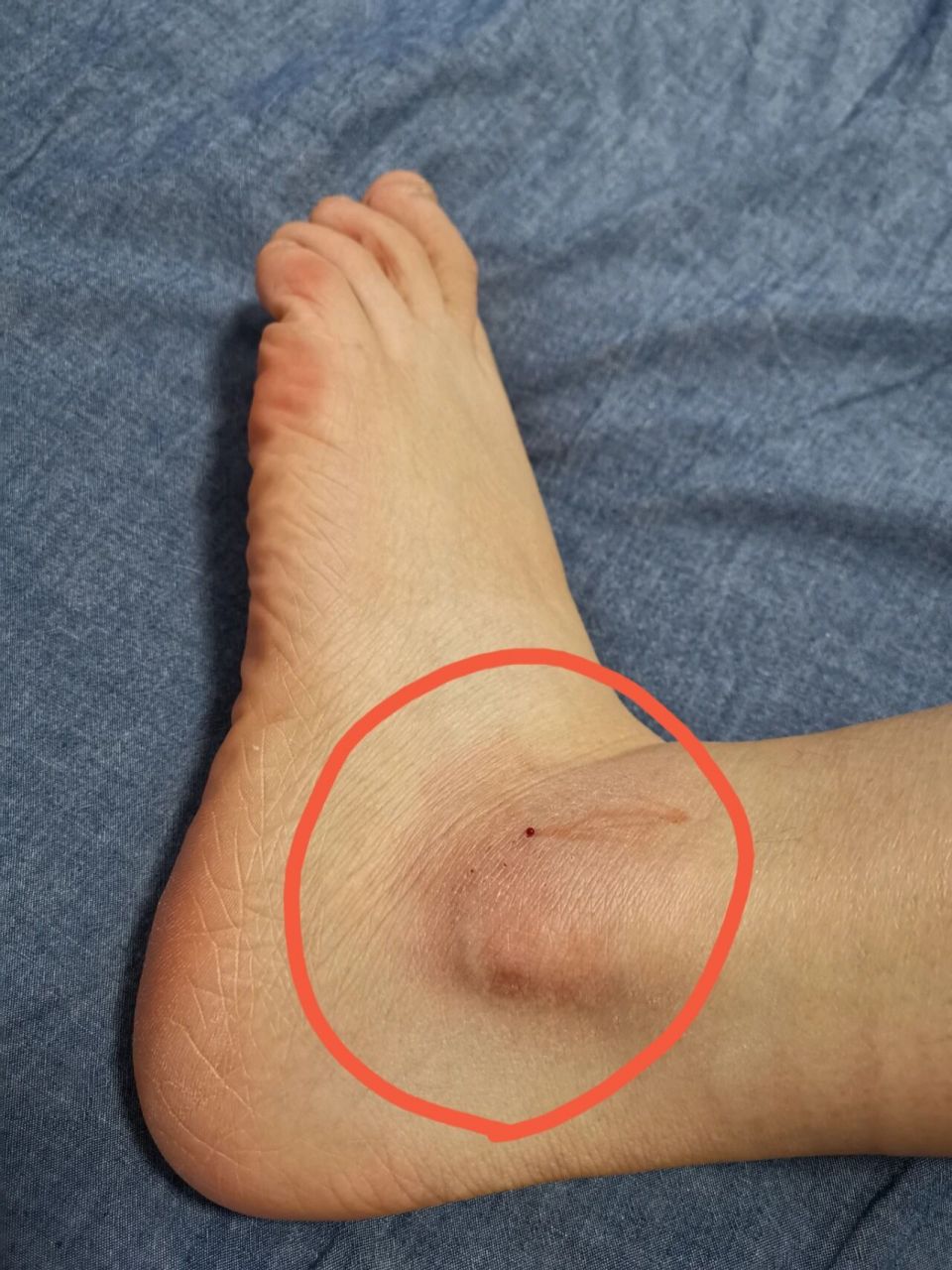 只有我一个人脚踝痒吗 最近几天开始左脚踝处奇痒无比!