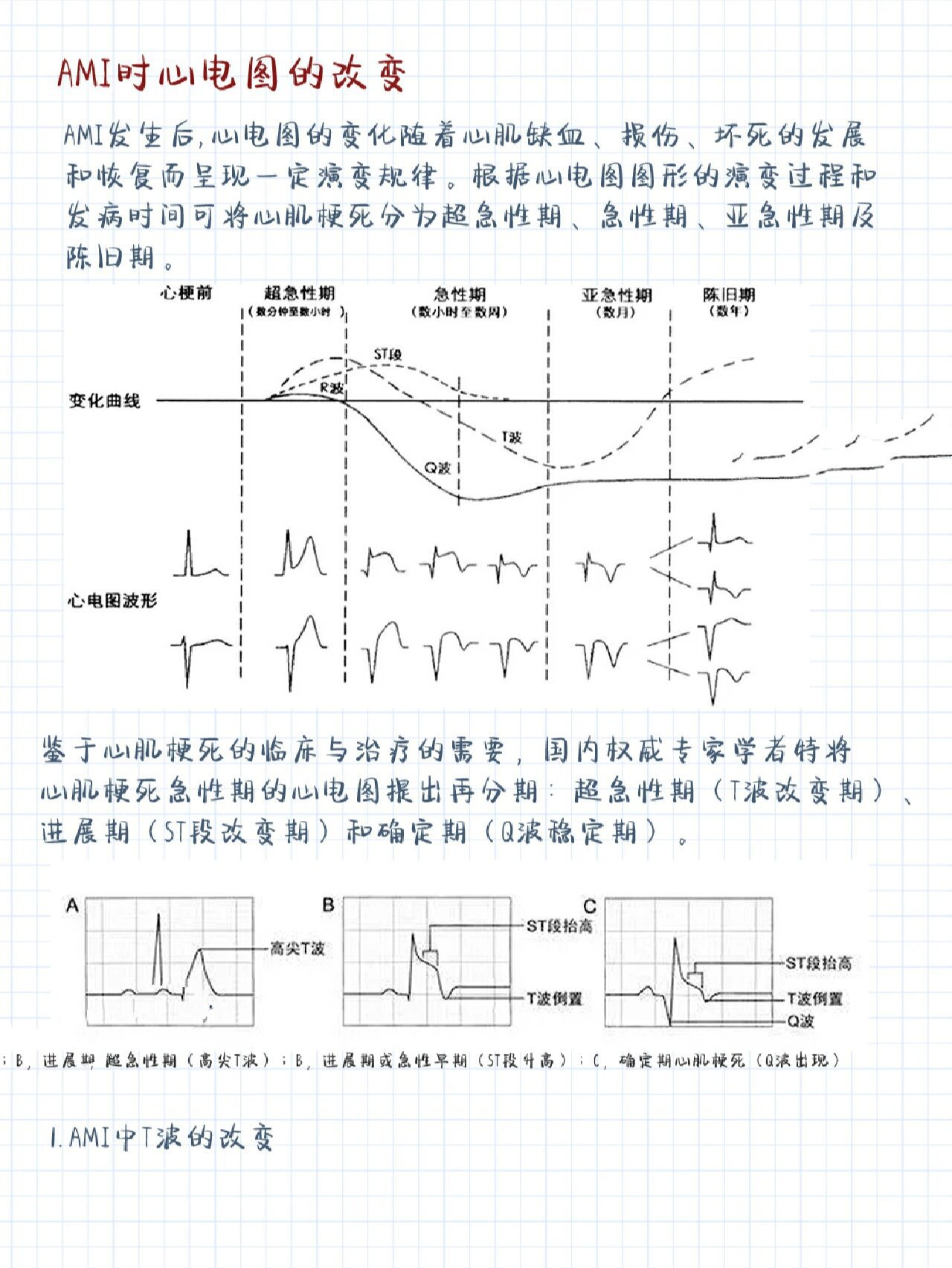 急性心梗心电图特点图片