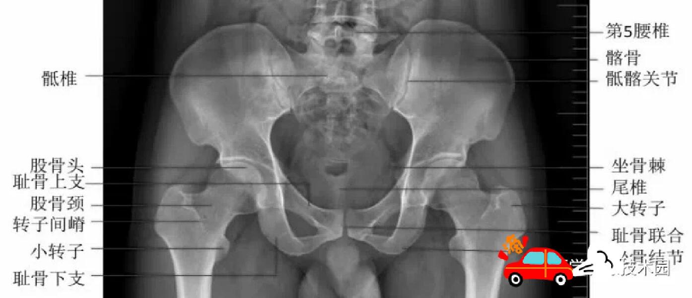 孩子的骨盆片报告怎么看?