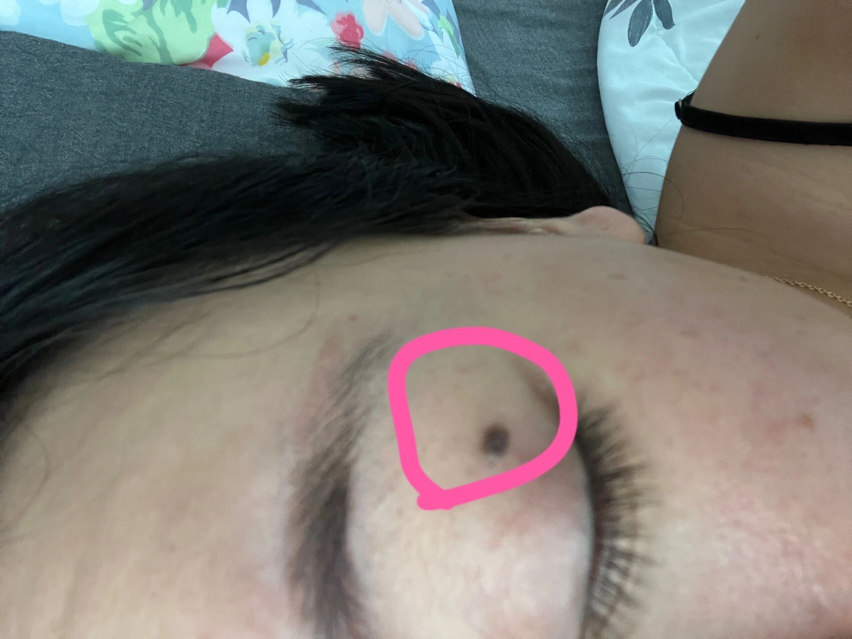 有没有姐妹知道,眼皮上的黑色肉痣可以点吗,去医院挂什么科,我想点了