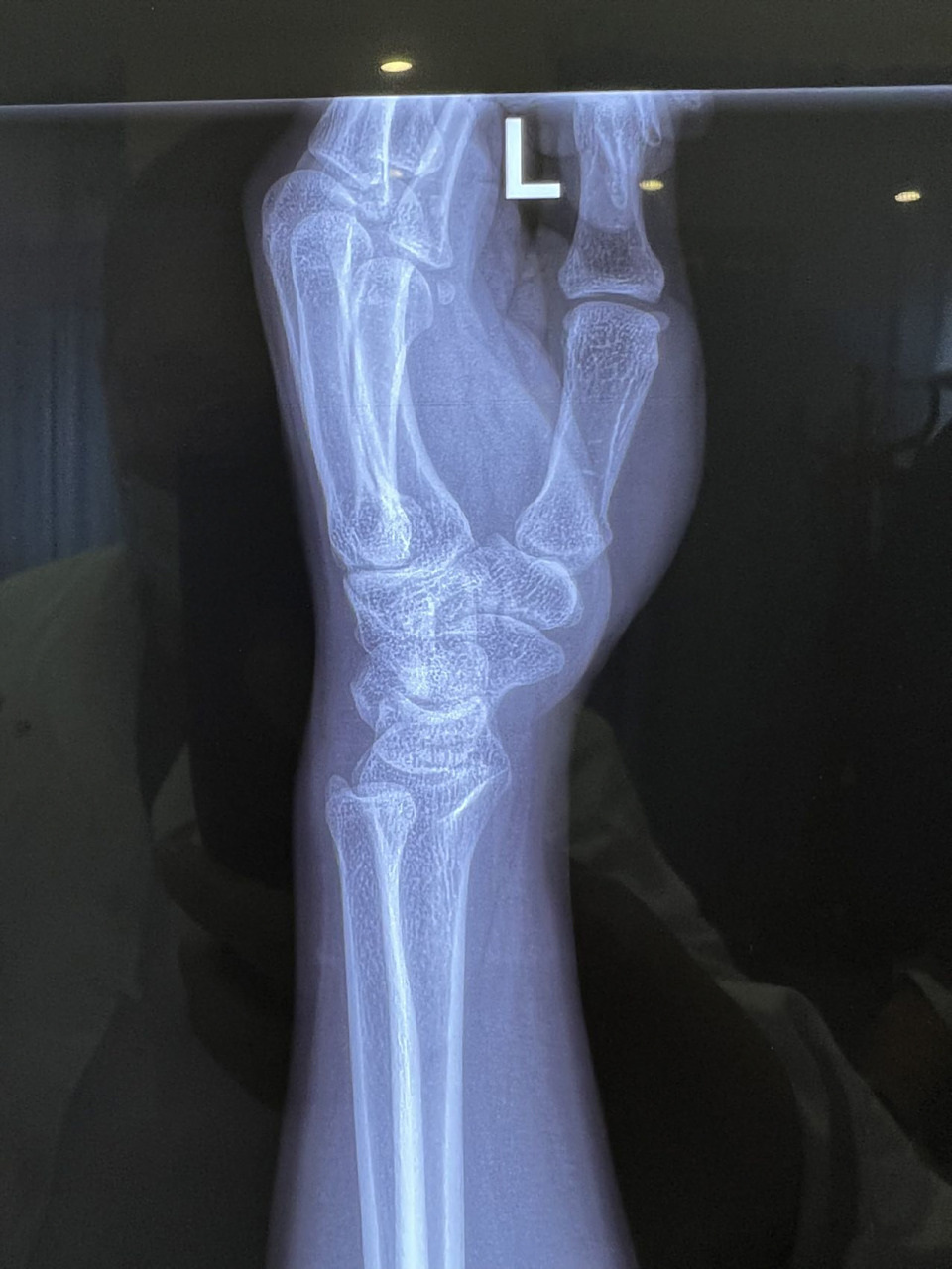 尺桡骨关节分离,手腕旋转疼痛 尺桡骨关节分离,导致手腕旋转疼痛.