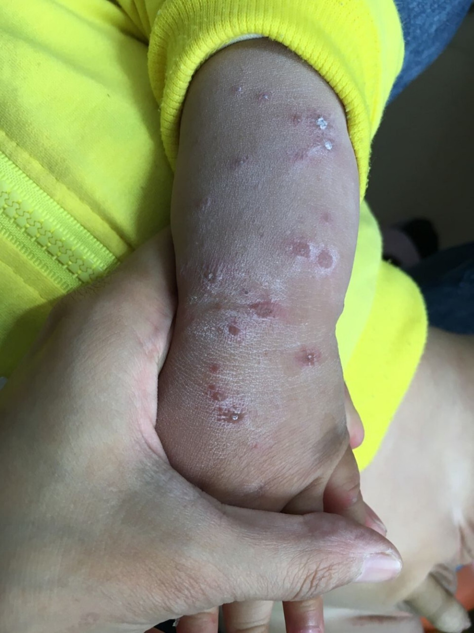 手足口疱疹 秋季干燥,病毒感染高发期,打了两针手足口疫苗后,小宝莫名