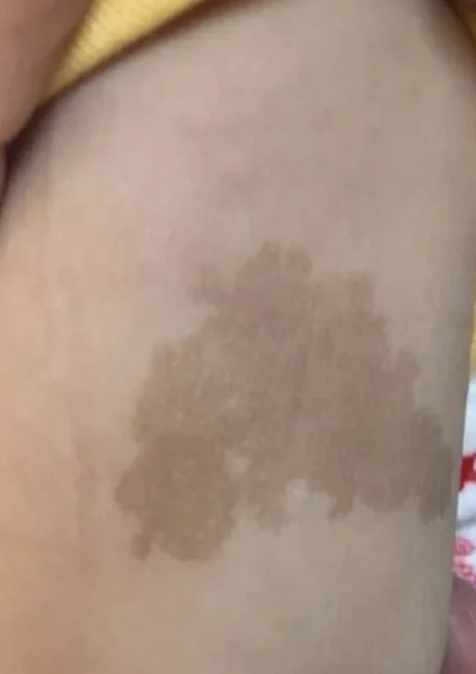 怎么办?  腹部出现褐色不规则斑块可能由多种原因引起