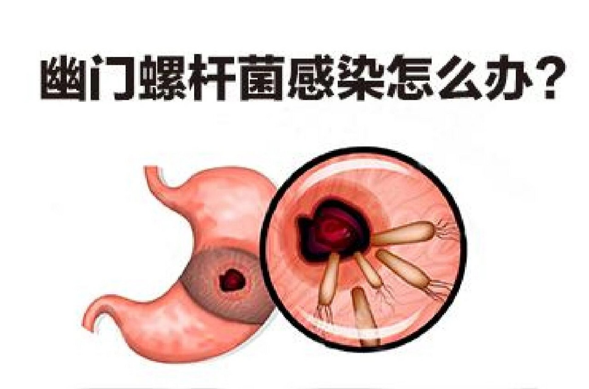 幽门螺旋杆菌感染的症状&治疗方法 大魔头胃癌的忠实小弟——幽门螺