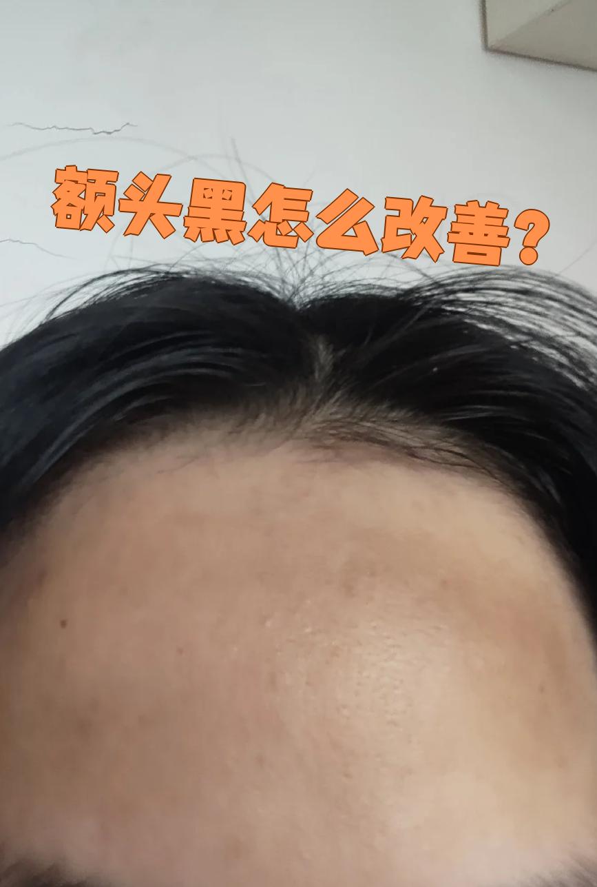 额头发黑要先搞清楚原因,常见的有色素沉着,慢性乙型肝炎,黑变病等