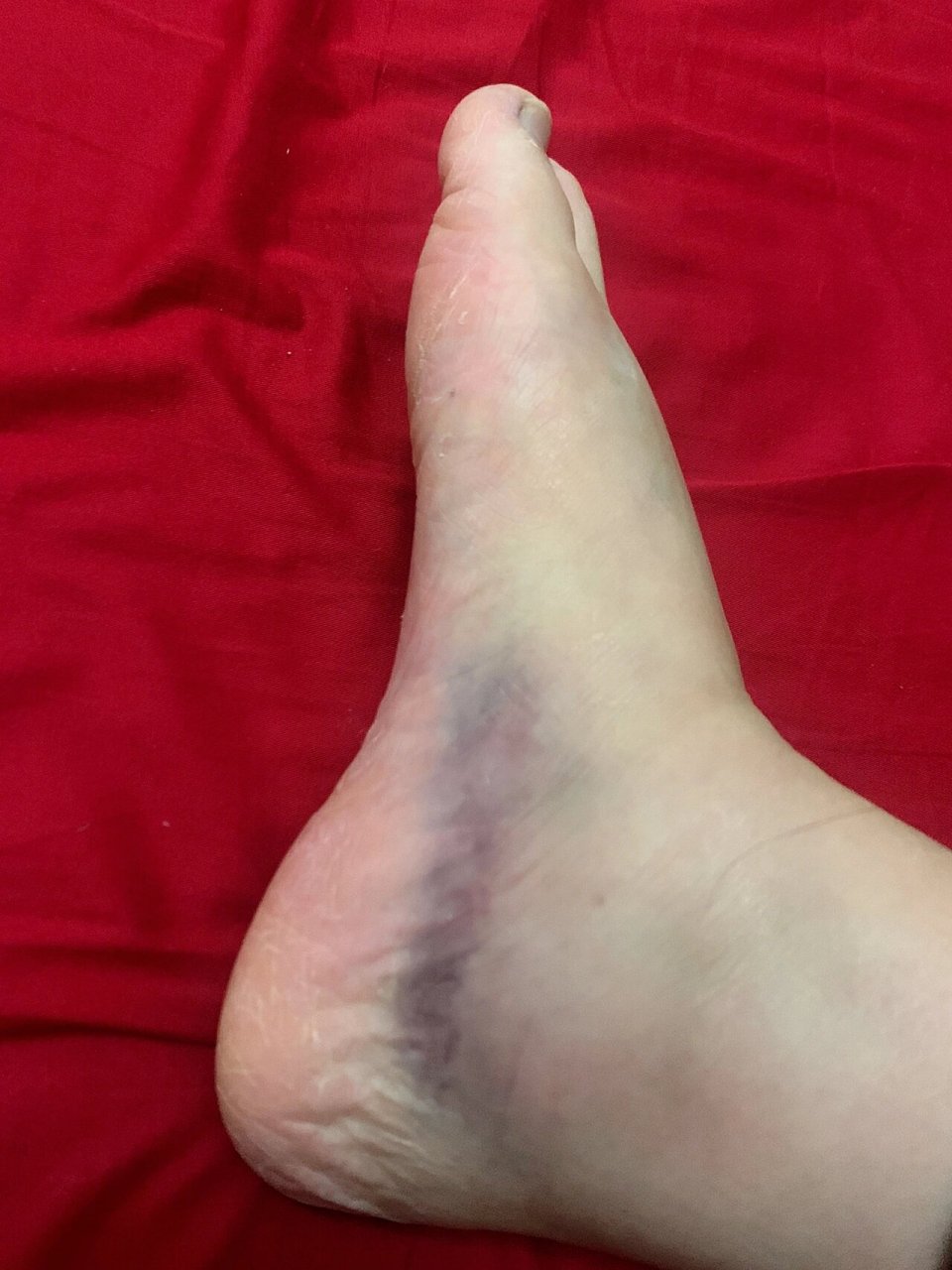 崴脚的第仨天,看着吓人,其实没那么疼了 第一天巨疼,第二天完全不能碰