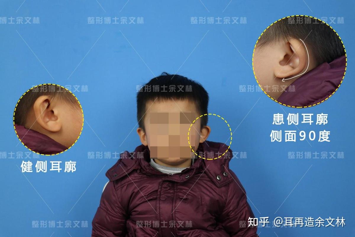案例分析杯状耳无法自行恢复妈妈带4岁儿子做手术矫正