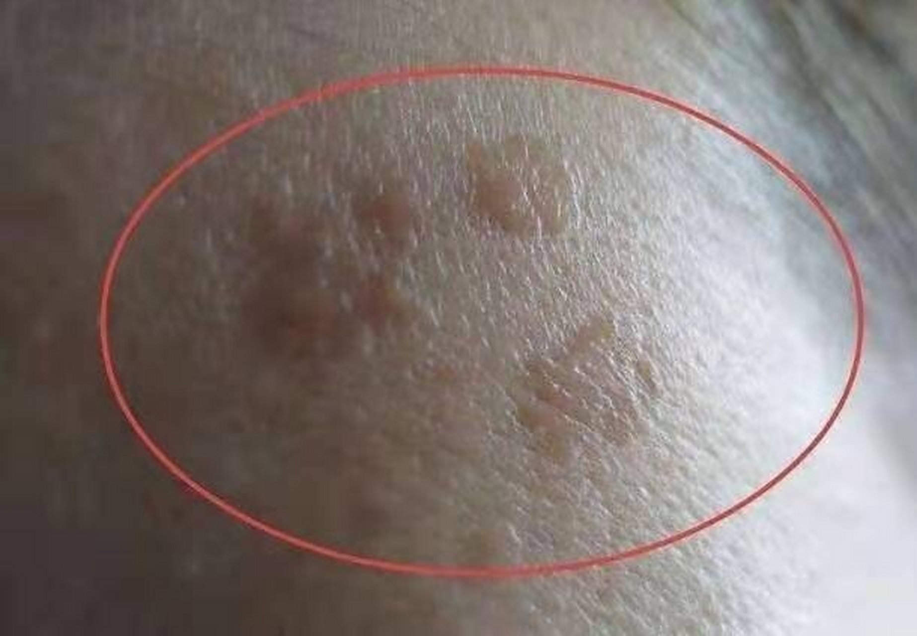 老人斑又叫老年斑,临床上叫做脂溢性角化病,当然也有老年人把它叫为