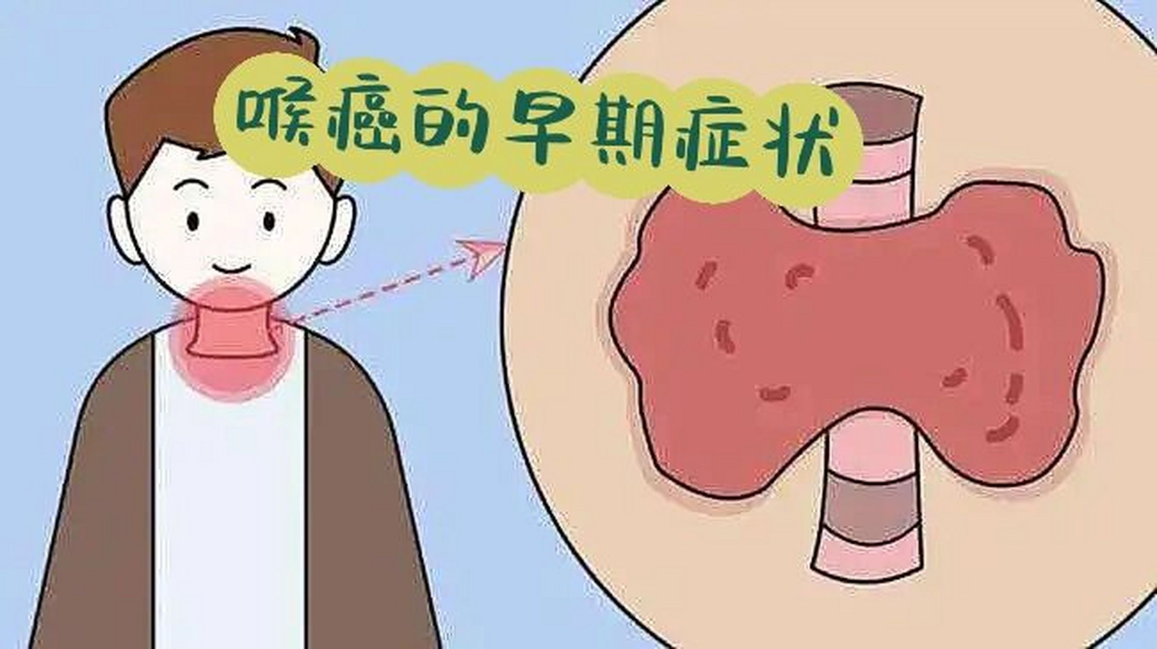 喉癌的早期症状有哪些93现代人高发疾病之一 95癌症的种类有很多