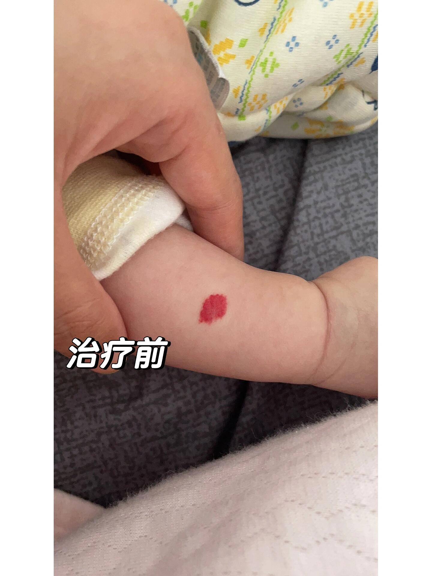 血管瘤快点好