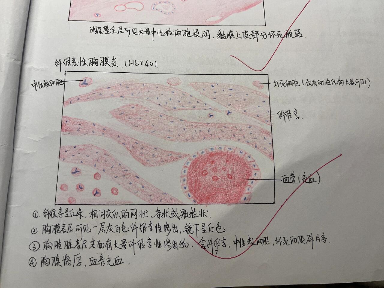 纤维素性胸膜炎,急性蜂窝织炎红蓝铅笔图 纤维素性胸膜炎 急性蜂窝织