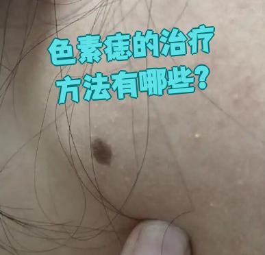 激光治疗适合直径小于两毫米,平于皮肤的色素痣