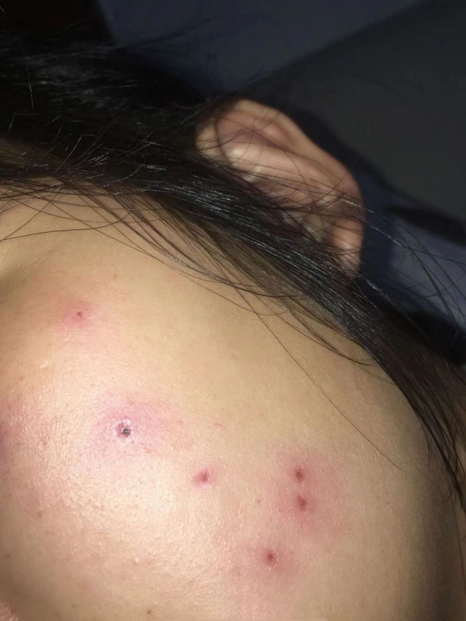 激光点痣真的可不留疤! 点痣有两个多月了,自我感觉恢复的还不错!