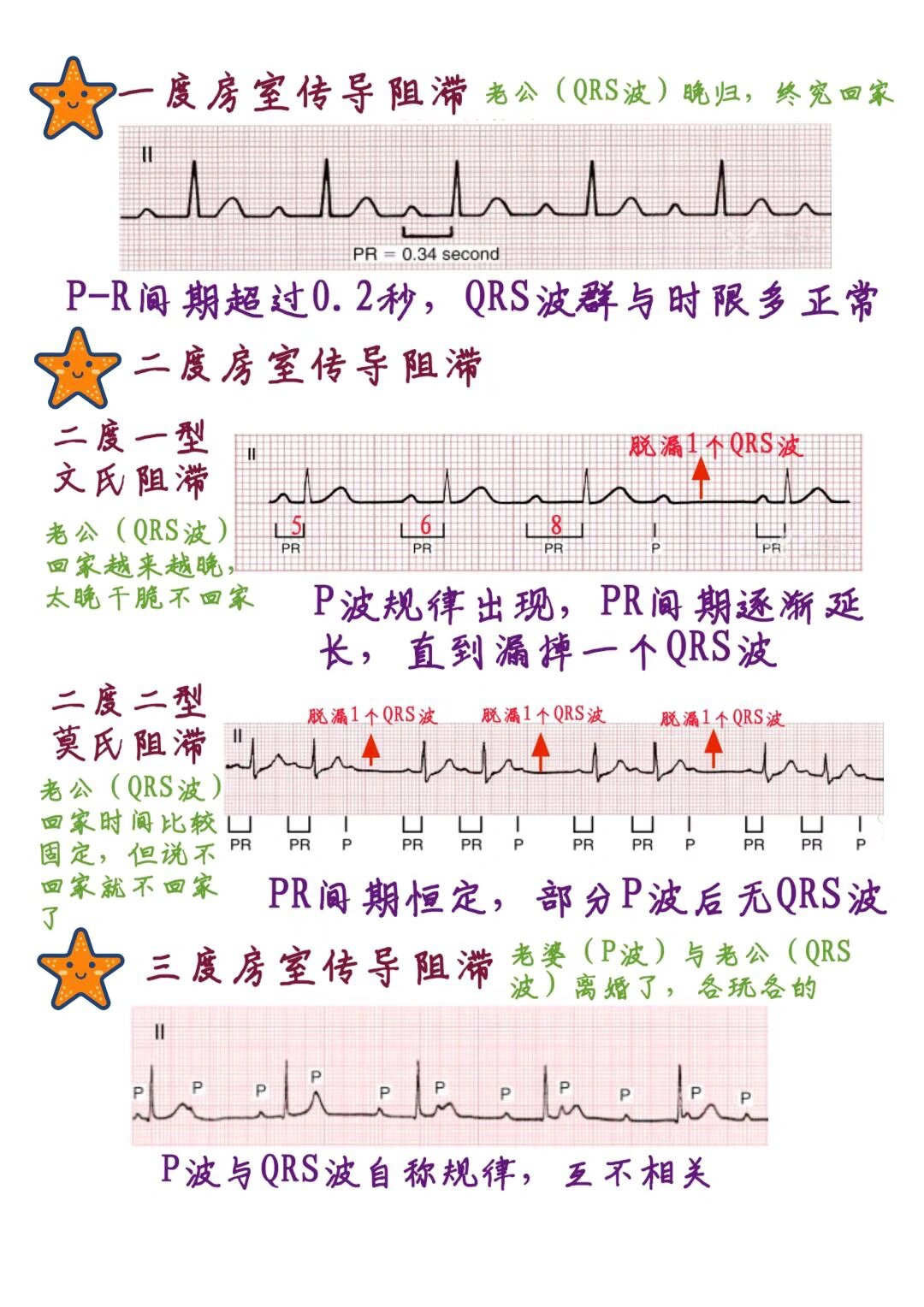 一张图学懂心电图