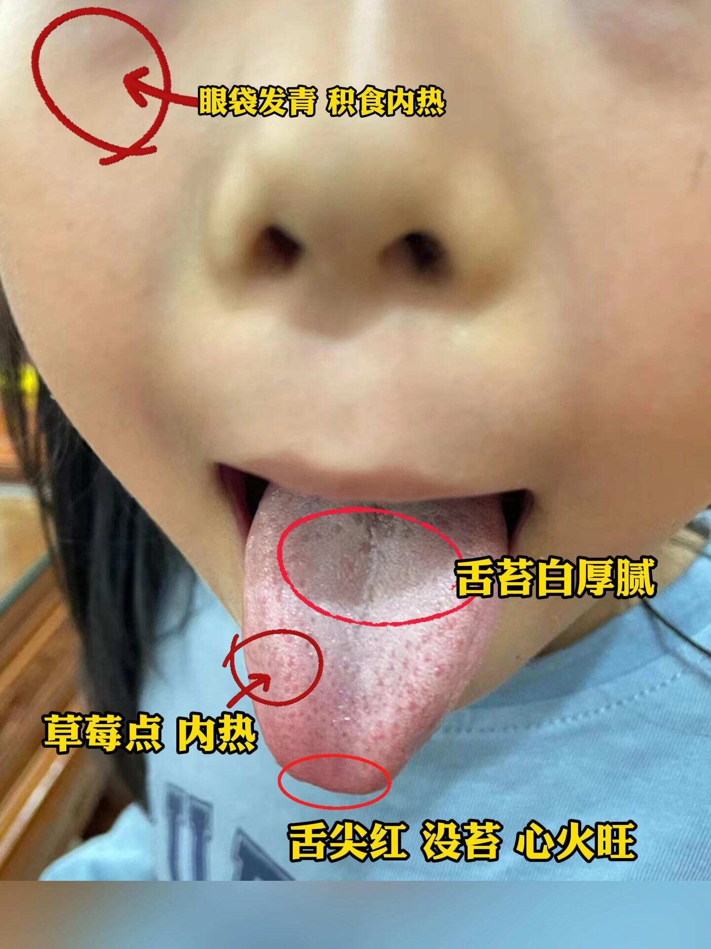 小孩子草莓舌图片