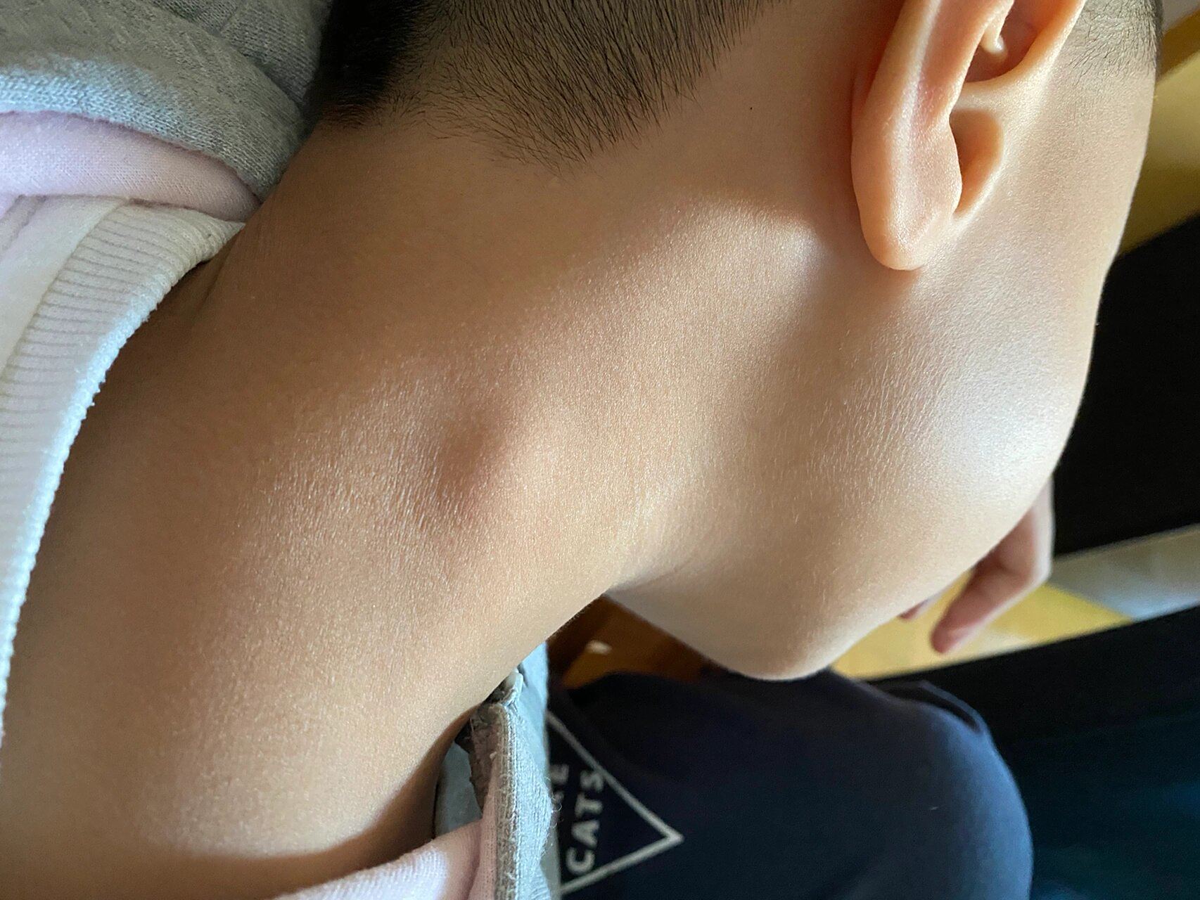 有人对淋巴结有了解吗 昨晚孩子自己摸到脖子有个包叫我看看,然后说不