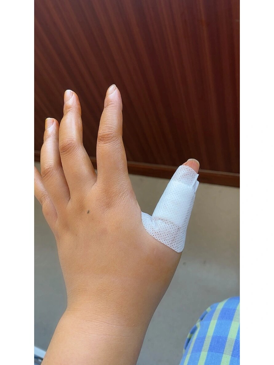 黄色纤维瘤(腱鞘巨细胞瘤) 莫名其妙会长的一种良性肿瘤,上海封闭管理