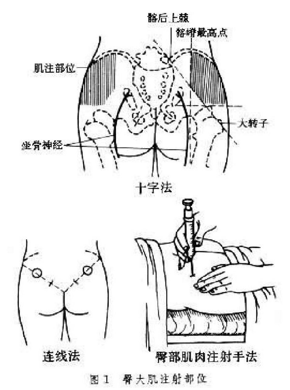 肌注定位法图片及定位图片