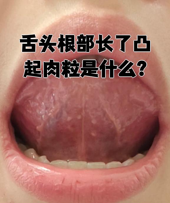 舌头根部长凸起肉粒可能是咽喉疱疹,滤泡性咽喉炎或舌乳头引起的