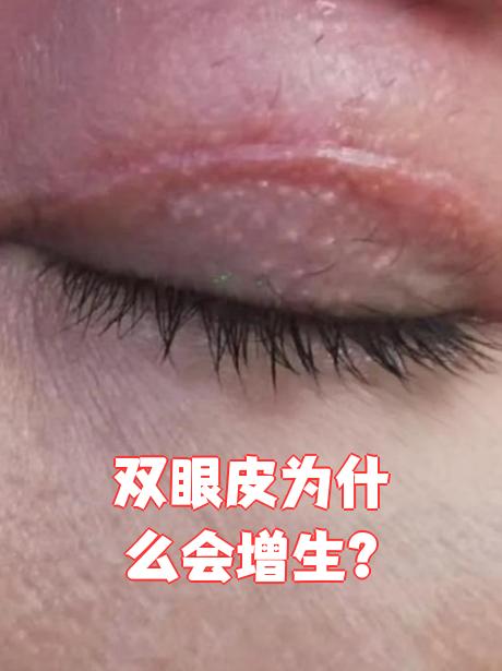 双眼皮为什么会增生?