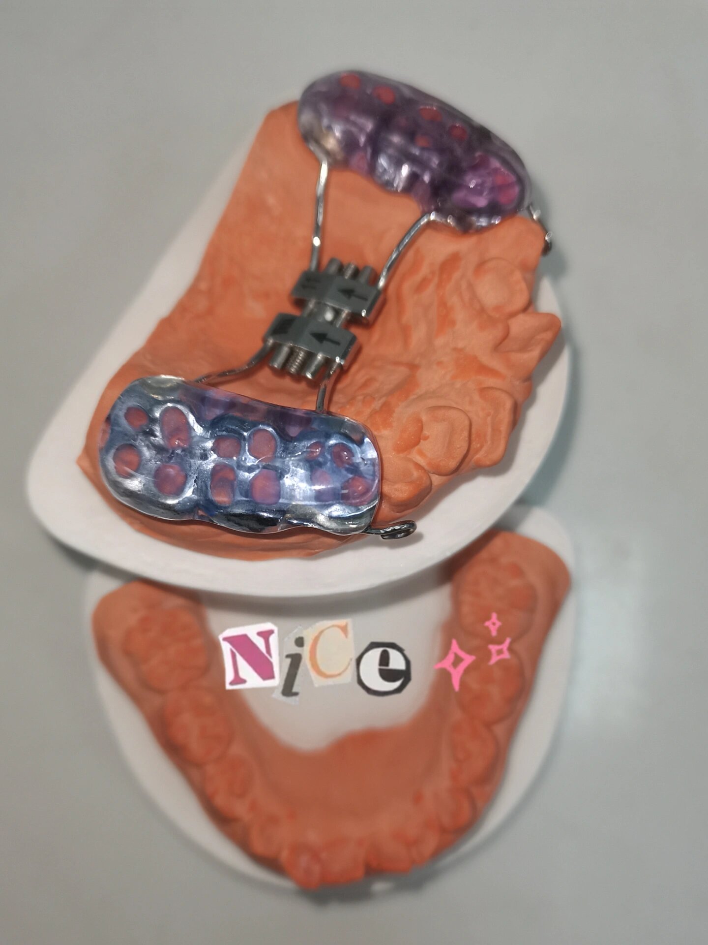 儿童早期矫治——快速扩弓77前方牵引6015 前方牵引口外部分即