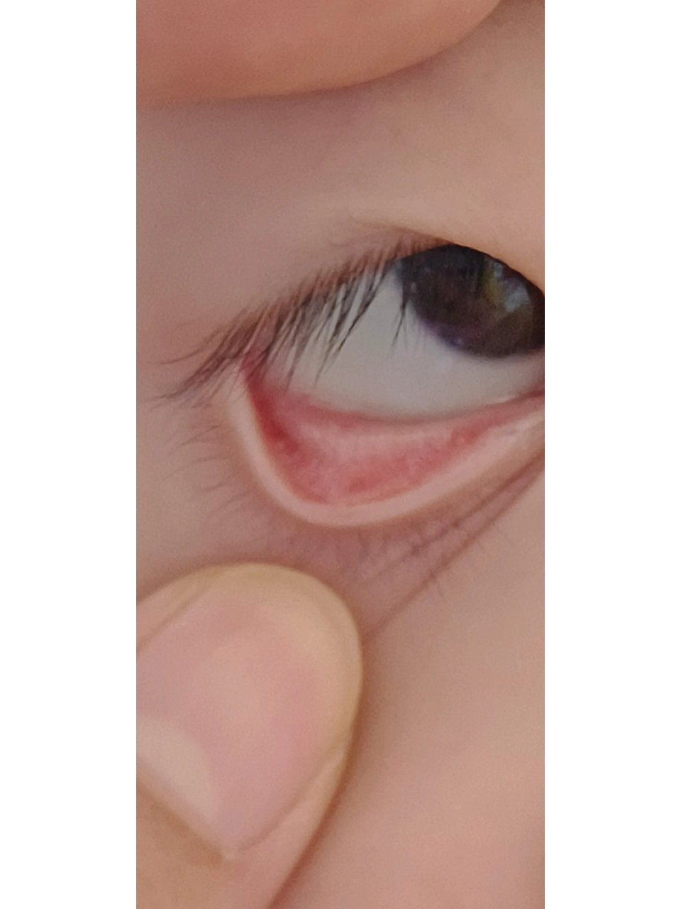 孩子下眼睑里面有透明泡泡什么原因? 紧急紧急 什么原因?