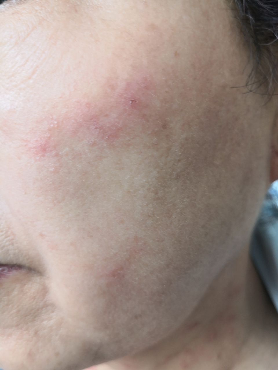 面颈部红斑风团症状,有的虹膜样改变.考虑多形性红斑.