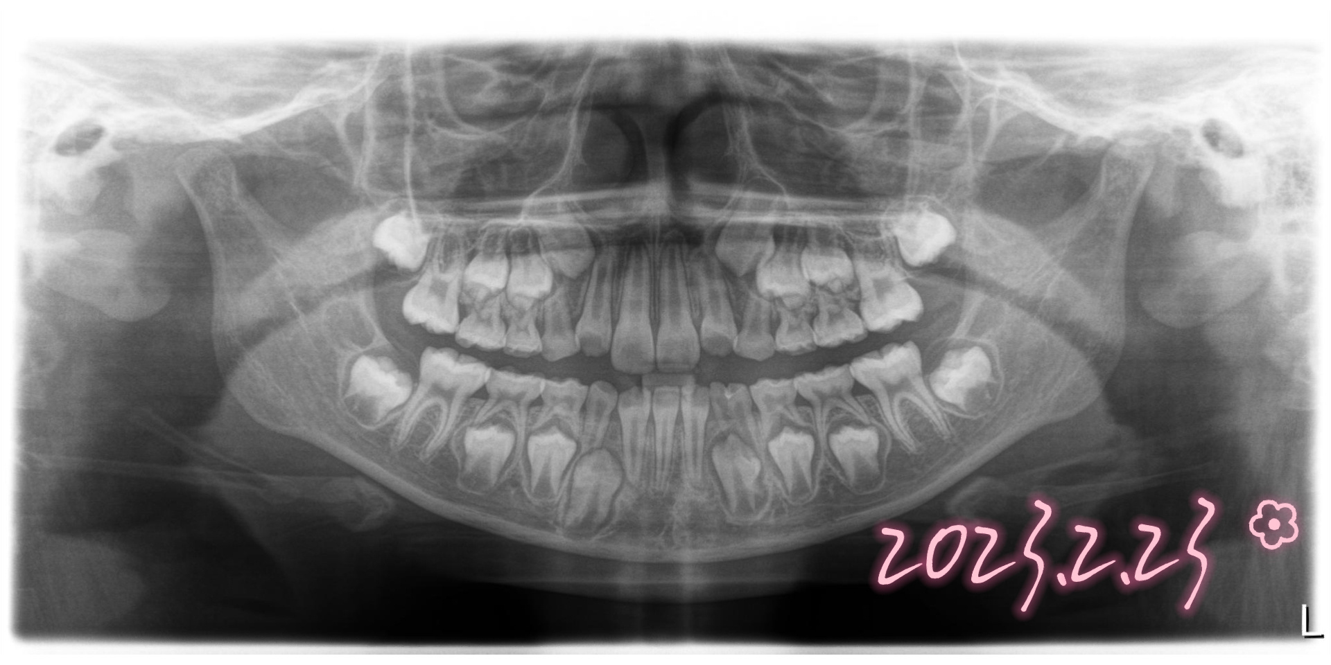 看看换牙情况 时隔一年半,我们又换掉了两颗二号牙,看看现在的x光片吧