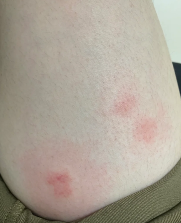 被蚊虫叮咬后大面积红肿怎么回事,怎么办?