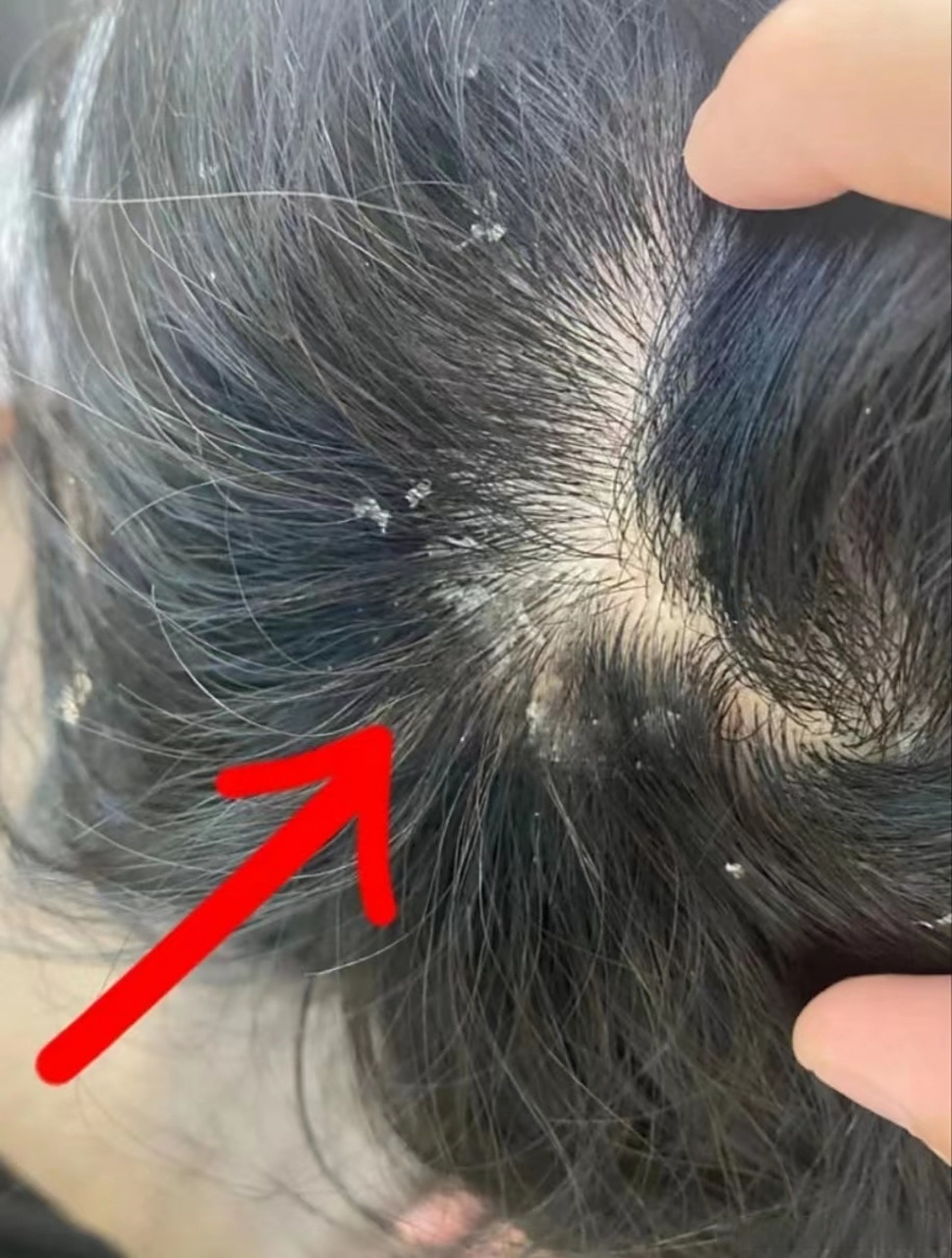 先搞清楚你是干性头皮屑还是油性头皮屑 96干性头屑大多是白色或