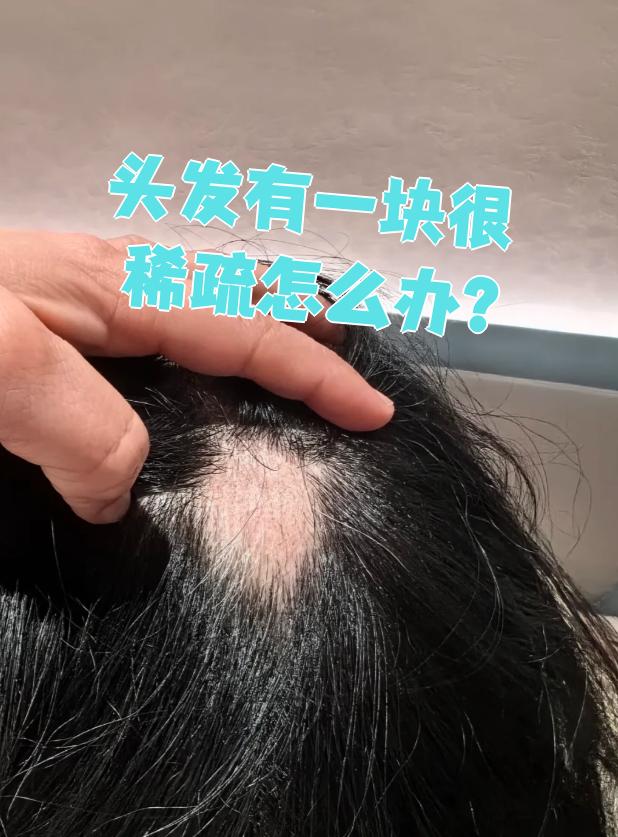 鬼剃头是因为什么原因引起的