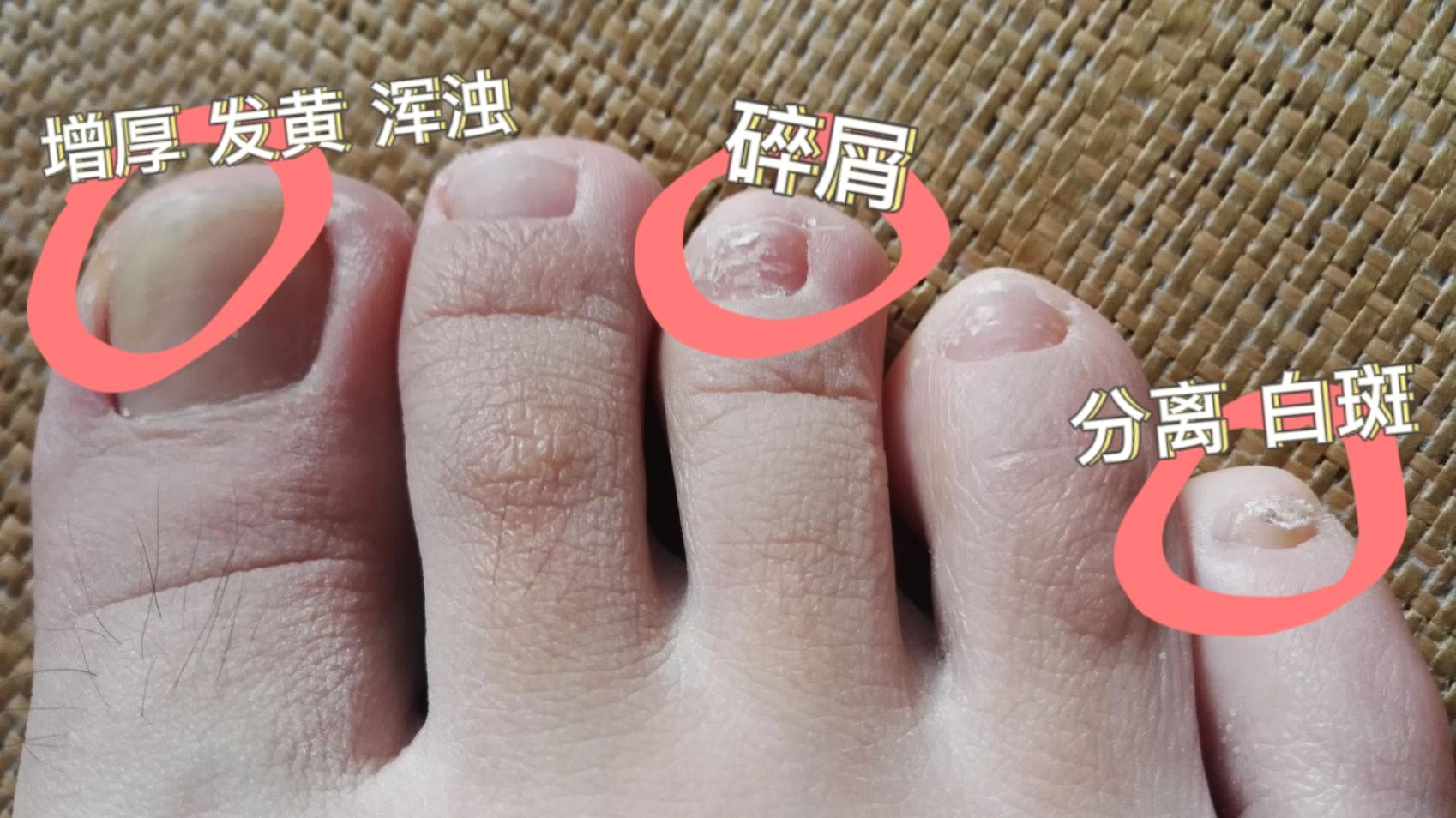 怎么判断是不是灰指甲