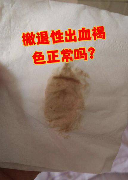 撤退性出血是褐色的话,一般属于正常情况