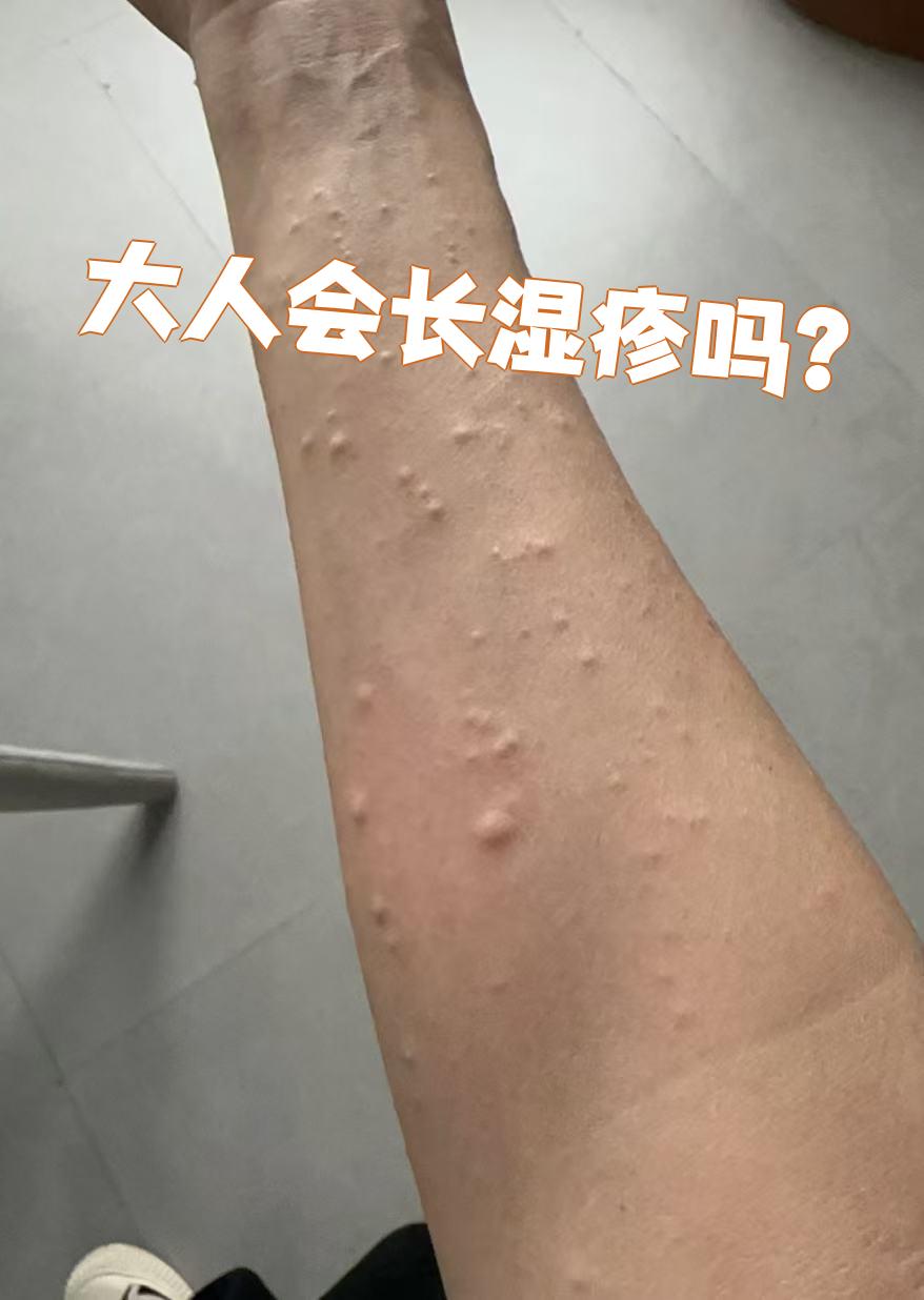 大人会长湿疹吗?