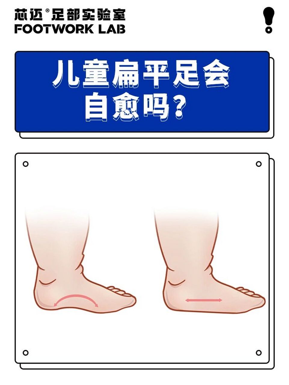 儿童扁平足可以自愈吗?   小孩子都没有足弓是怎么怎么回事呢?