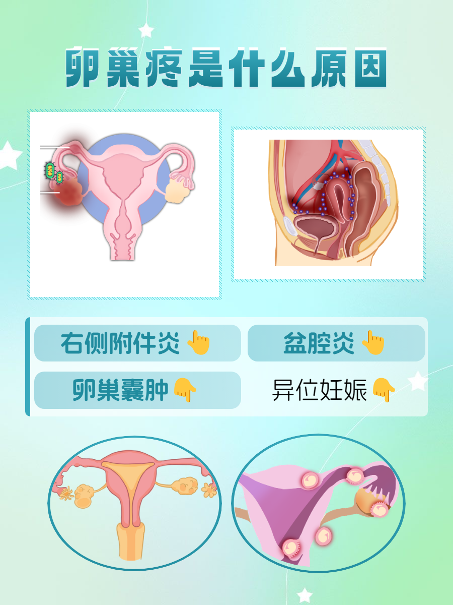 右侧附件炎:附件含卵巢和输卵管,炎症刺激周边组织神经,引发卵巢部位
