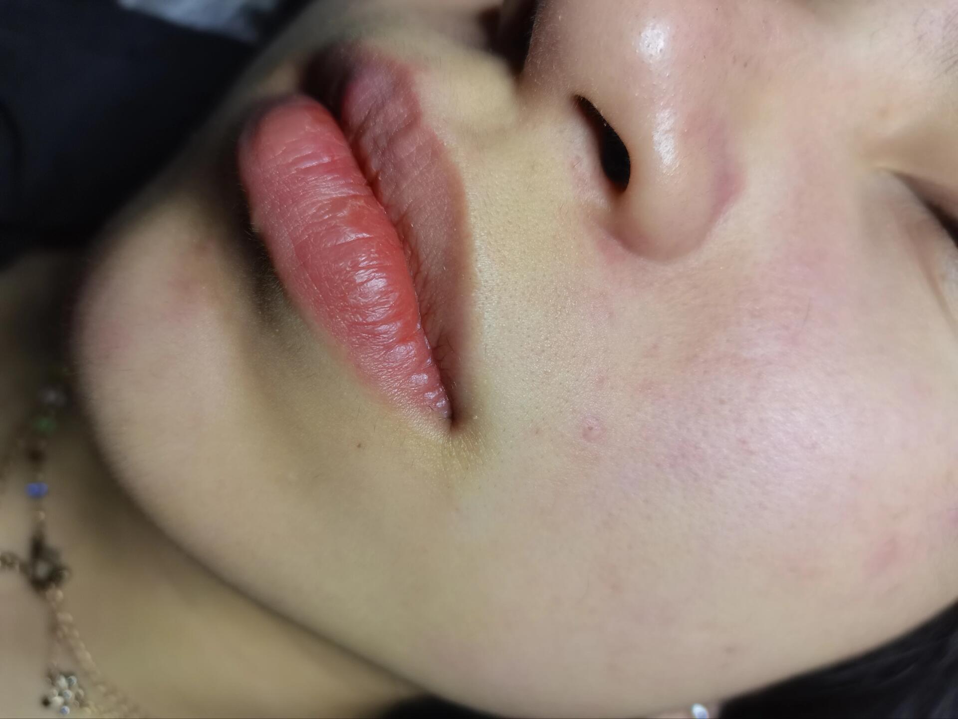 唇部脱毛对比图精致不是一点点整个肤色都亮