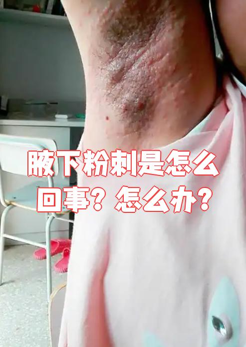 腋下长粉刺主要是因为皮脂腺分泌太旺盛