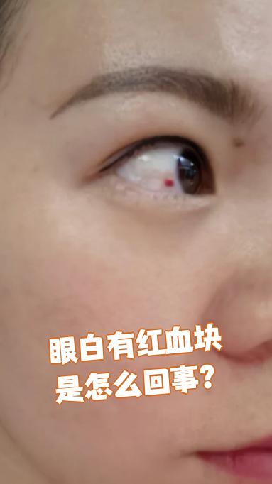 眼白出现红血块最常见的原因是结膜炎或结膜下出血