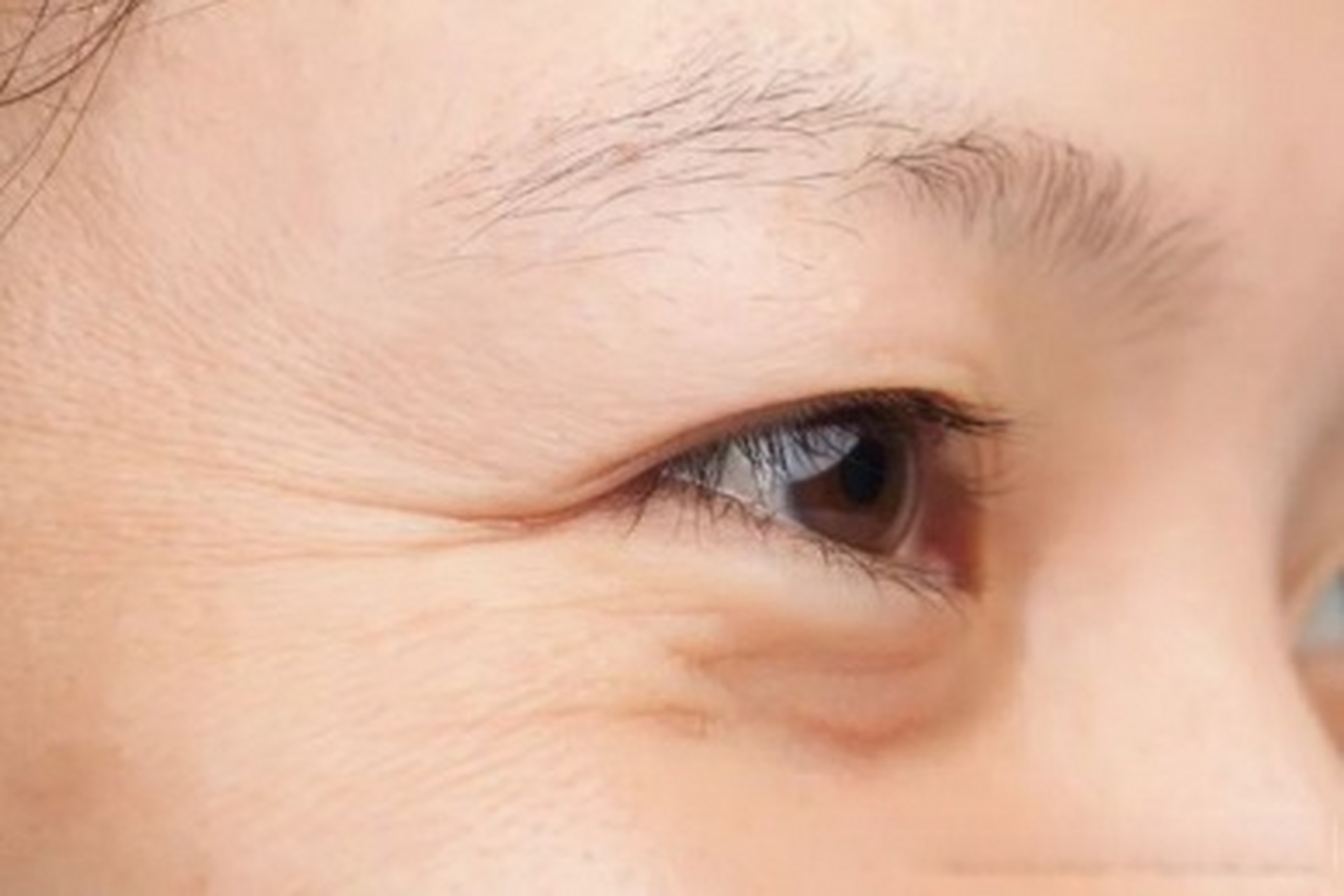 打完鱼尾纹,眼下细纹增多了?