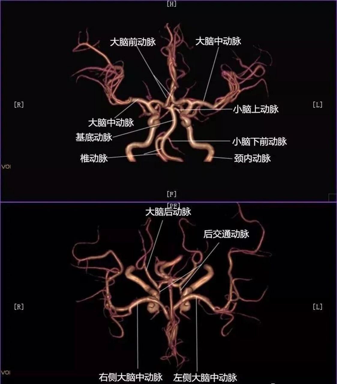 大脑动脉环影像图图片