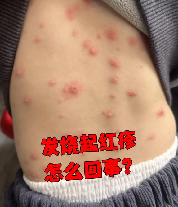 是什么病毒感染会引起发热和起丘疹呢的简单介绍