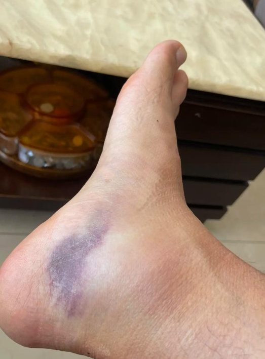 脚崴了10天淤青越来越严重,这种情况需要分两方面来看