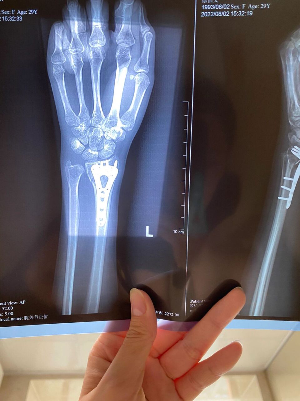 手腕骨折日记第65天 术后一个半月去拍了正侧位的x光,然而骨头还是