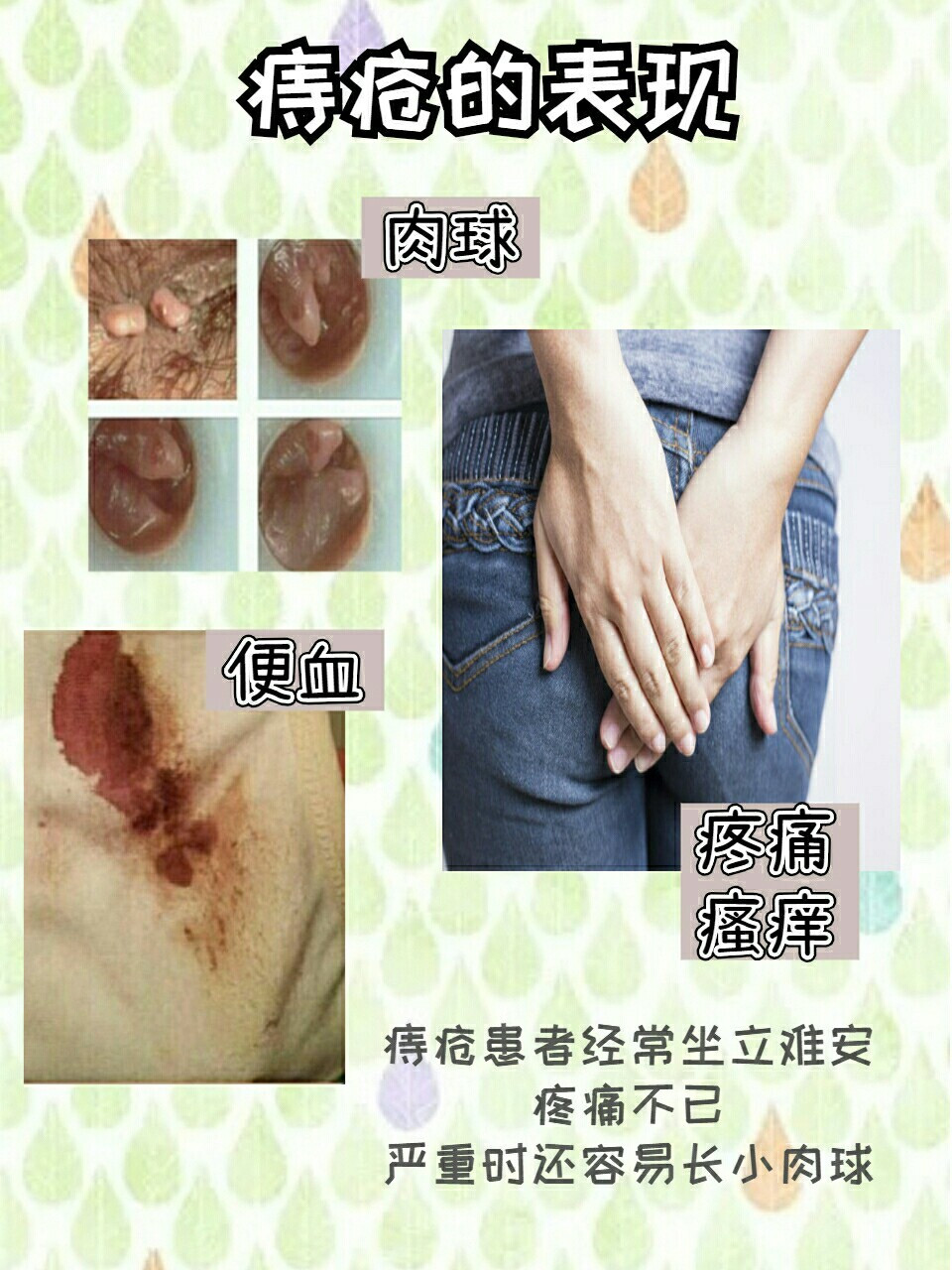 消痔疮去肉球,折磨我的痔疮终于好了78 痔疮想必很多人都得过