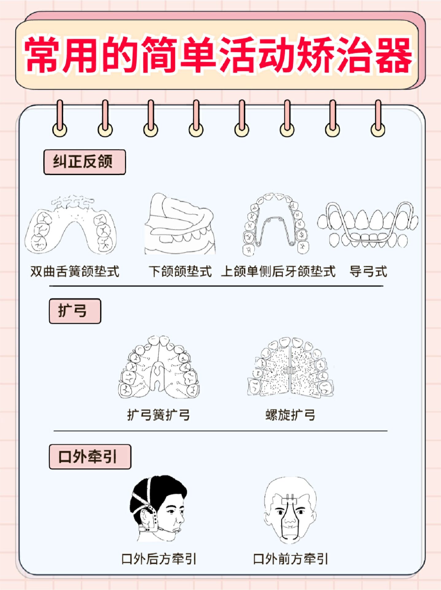 颌垫舌簧矫治器原理图片