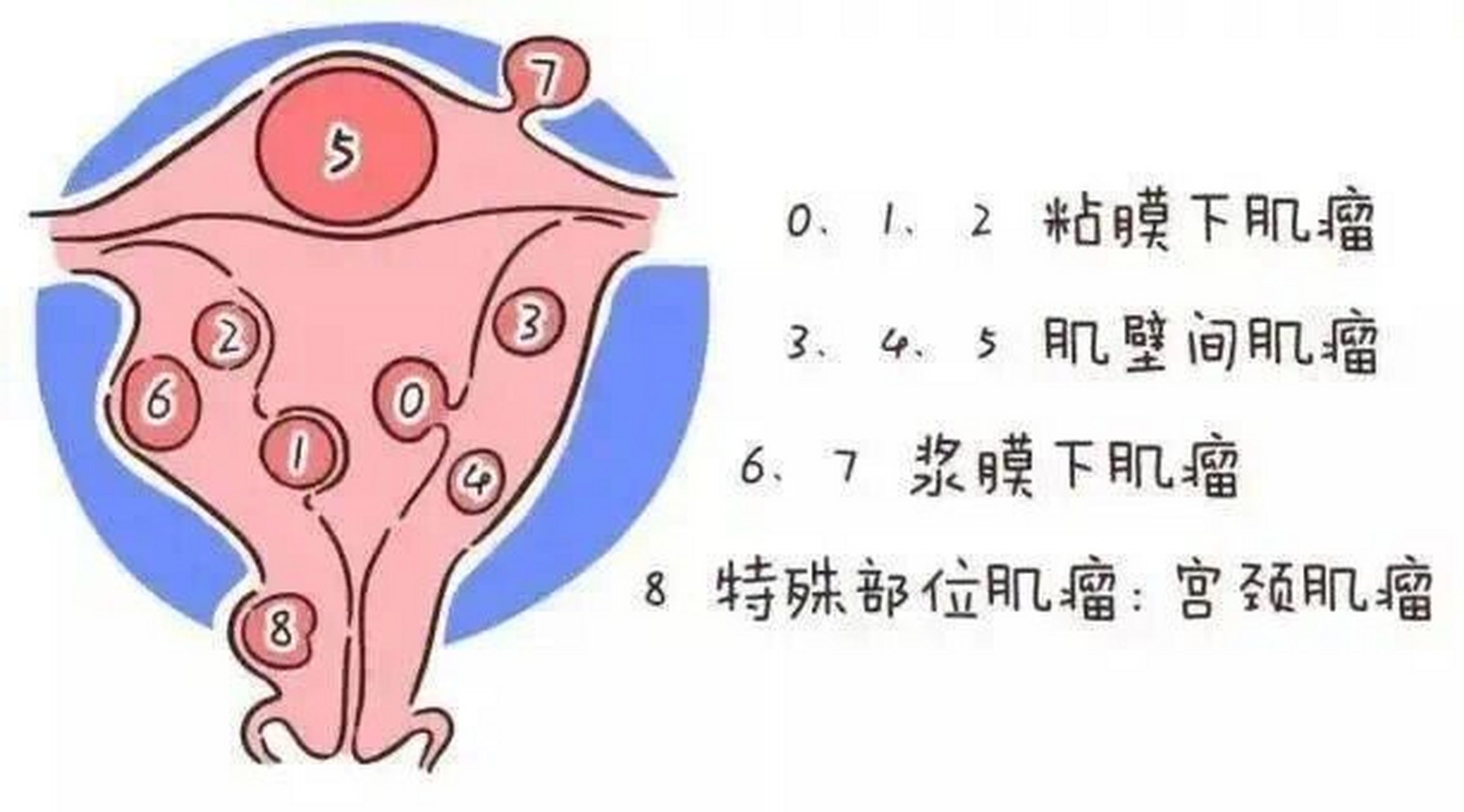 子宫腺肌症示意图图片